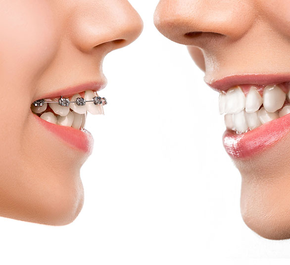 braces and teeth aligners